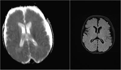 The effect of extracorporeal membrane oxygenation on neurodevelopmental outcomes in children after repair of congenital heart disease: A pilot study from Turkey